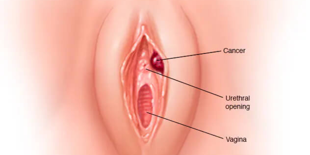 Меланома вульви