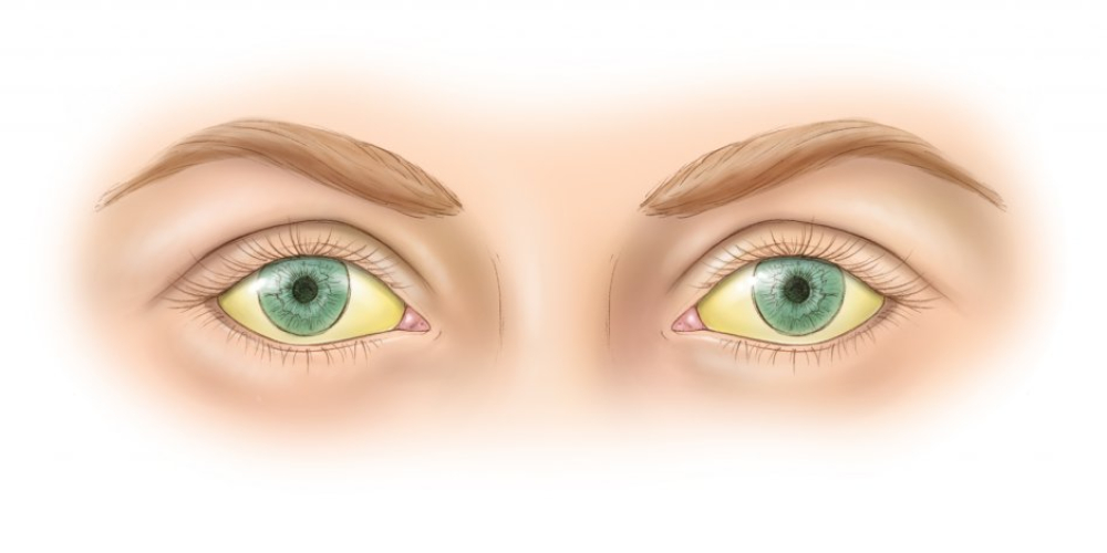 Механическая желтуха