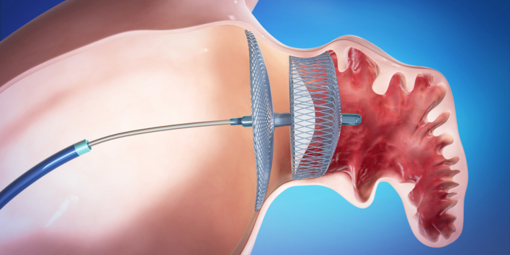 Установка окклюдера