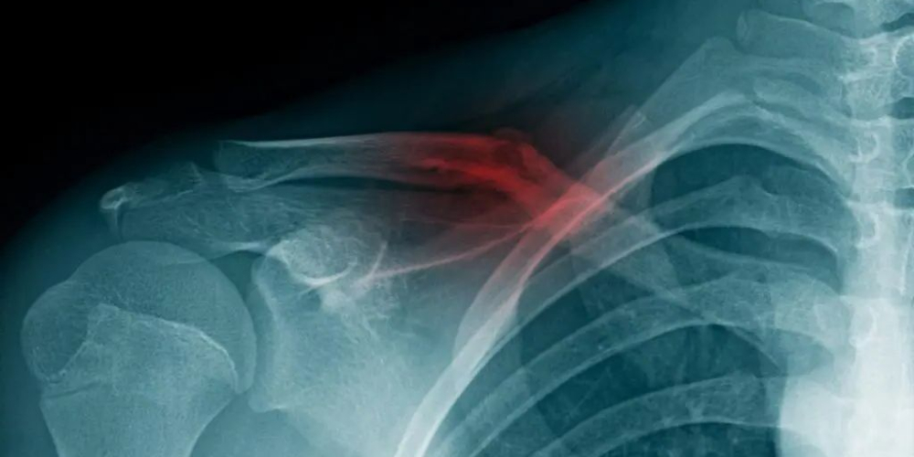 Перелом ключицы