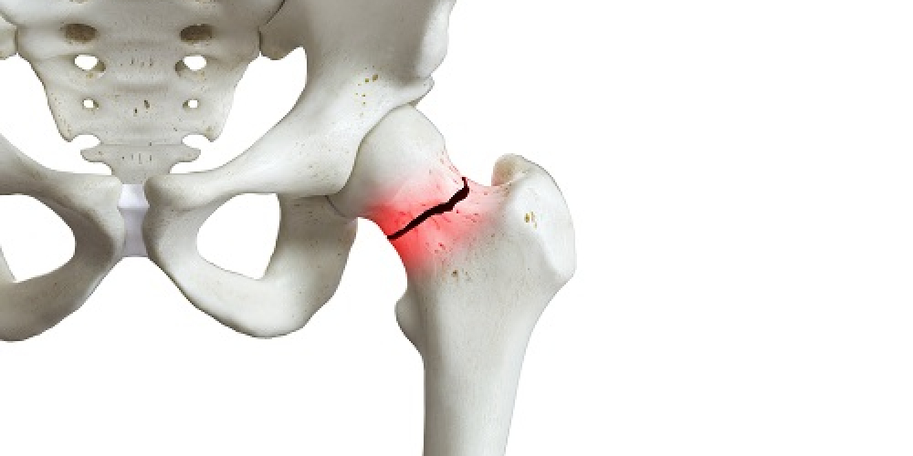 Перелом шейки бедра