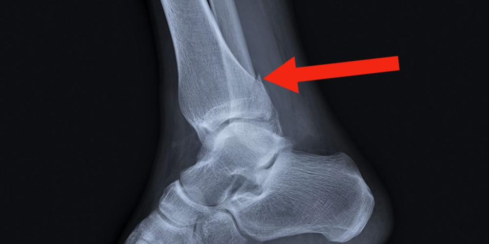 Переломы лодыжек