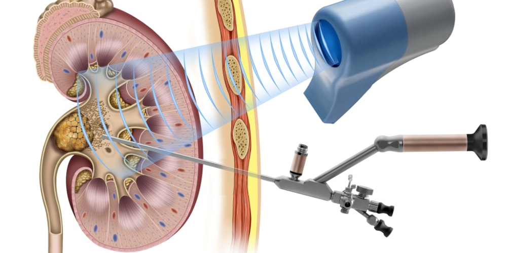 Перкутанна нефролітотрипсія (ПНЛ)