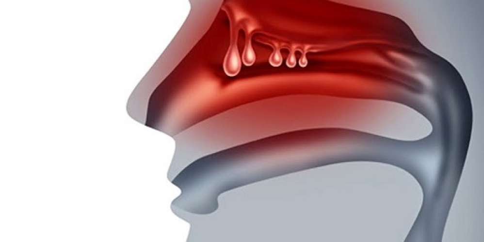 Поліпи в носі