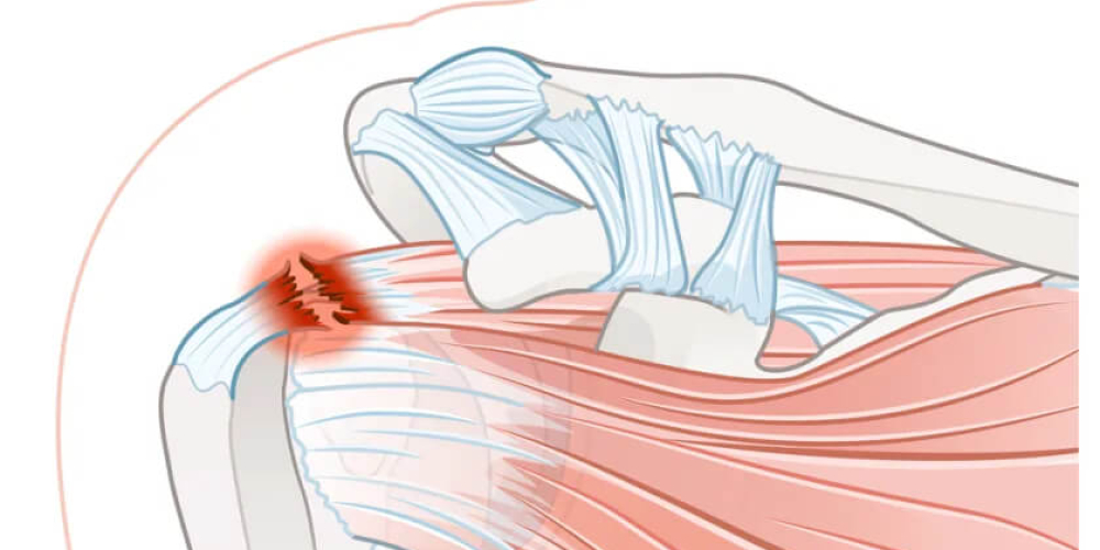 Повреждение вращательной манжеты плечевого сустава Повреждение вращательной манжеты плечевого сустава