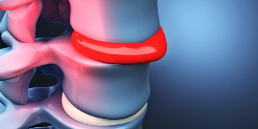 Протрузия межпозвоночного диска
