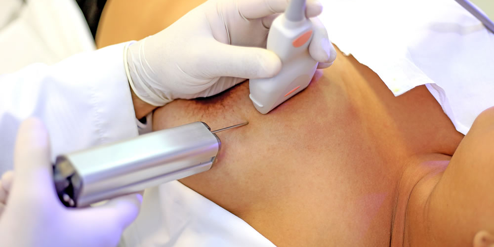 Тонкоигольная пункционная аспирационная биопсия образований молочной железы Тонкоигольная пункционная аспирационная биопсия образований молочной железы