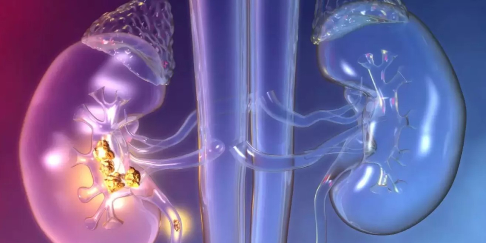 Рак почки Рак почки