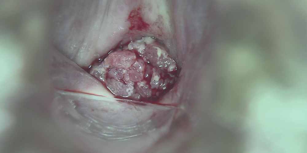 Рак шейки матки