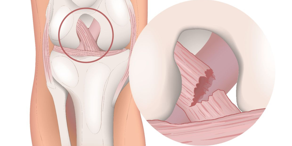 Разрыв крестообразной связки