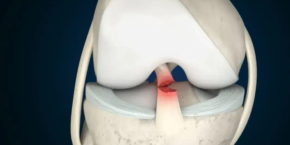 Разрыв передней крестообразной связки