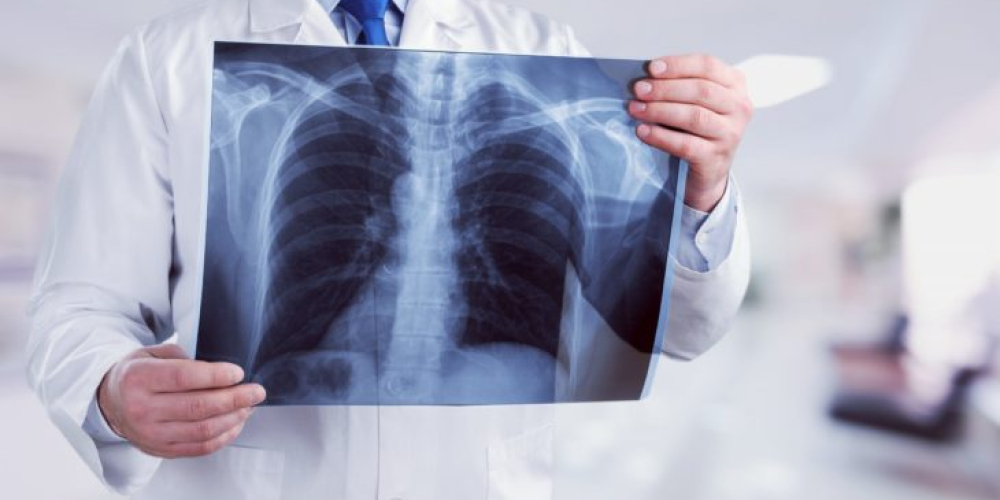 Рентгенографія грудної клітки (рентген легень)
