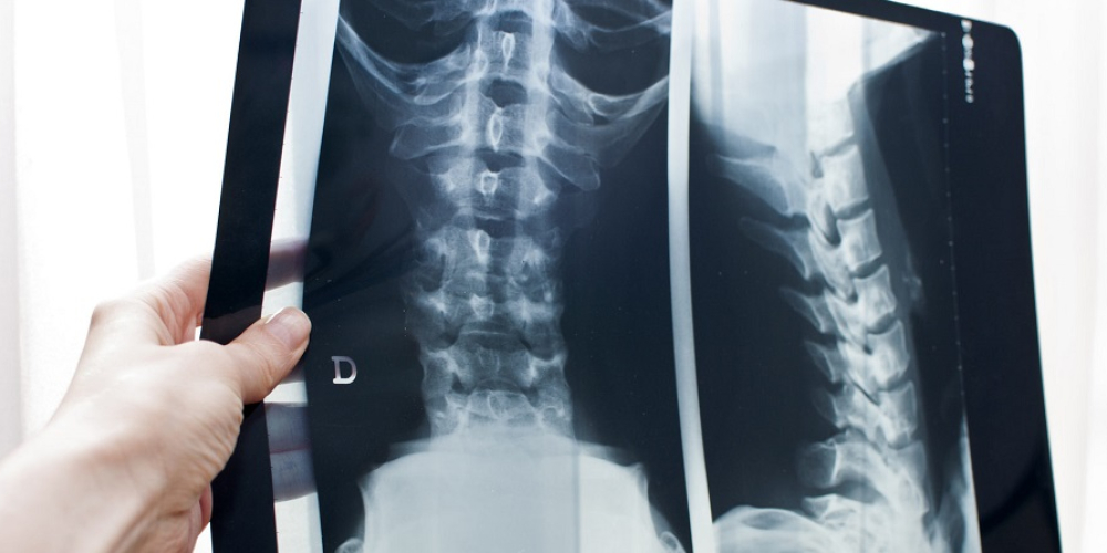 Рентген позвоночника (рентген спины)