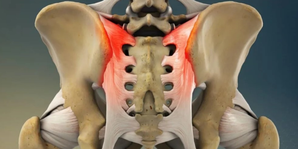 Сакроілеїт