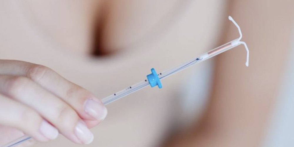 Установка внутриматочной спирали