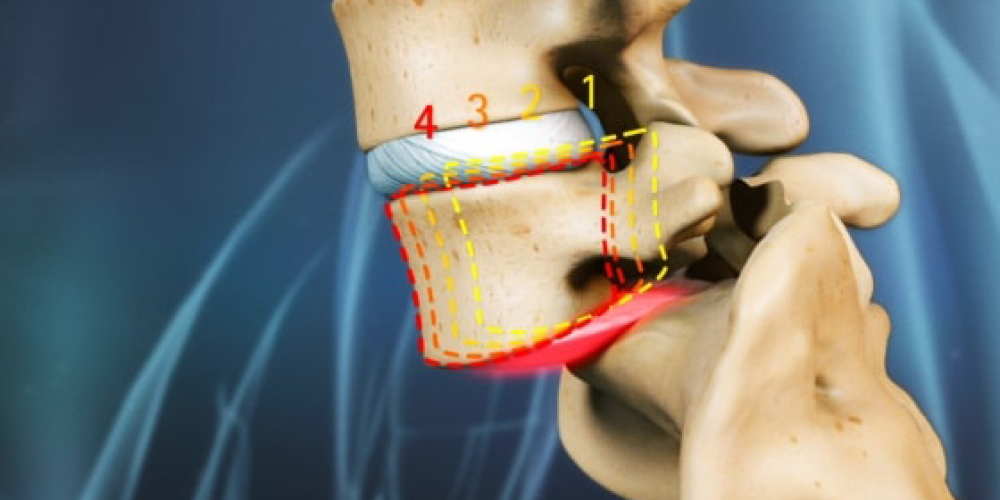 Спондилоартроз