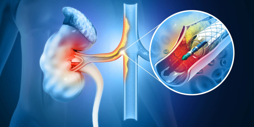 Стентирование почечной артерии