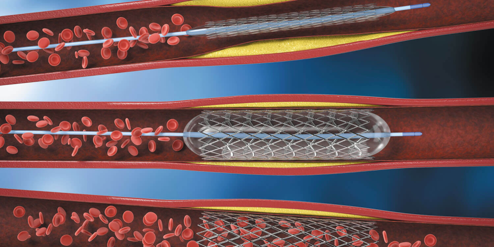 Стентування серця (коронарне стентування)