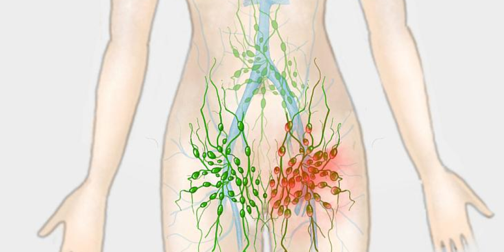 Тазовая лимфаденэктомия