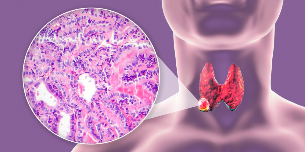 Рак щитовидної залози