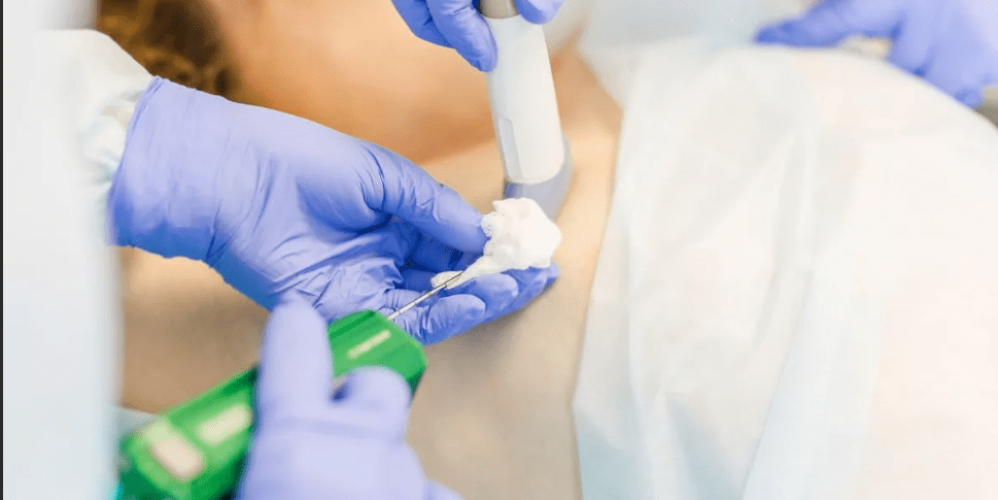 Трепан-биопсия молочной железы