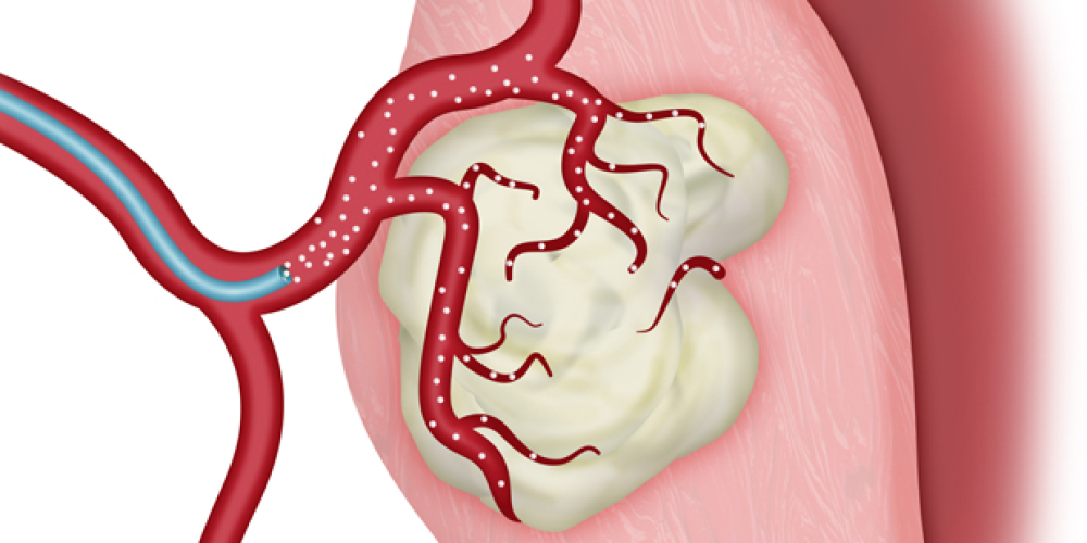 Эндоваскулярная хирургия (сосудистая)