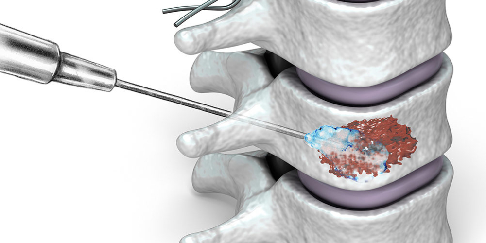 Вертебропластика
