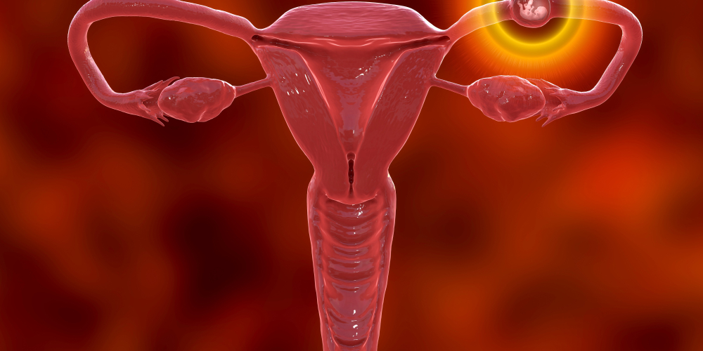 Внематочная беременность