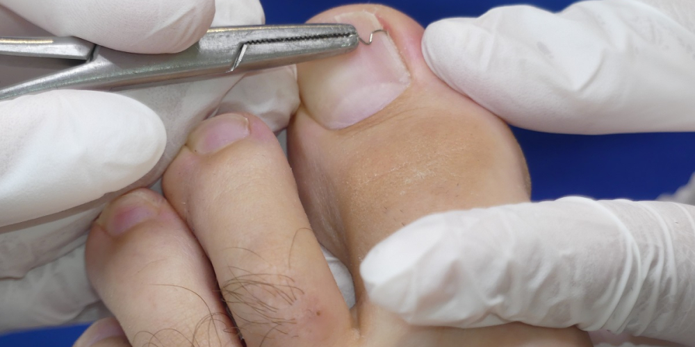 Вросший ноготь